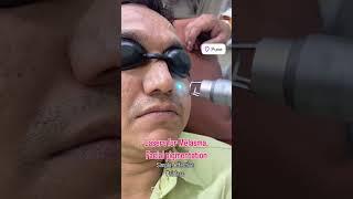 #shorts Lasers for Melasma, Facial Pigmentation |Dr. Rashmi Aderao Skin Hair Laser Clinic