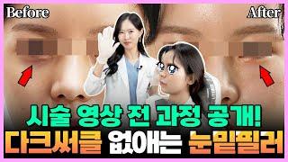 자연스러운 눈밑필러 시술영상 전 과정 공개! 눈밑필러후기, 부천눈밑필러, 부천피부과