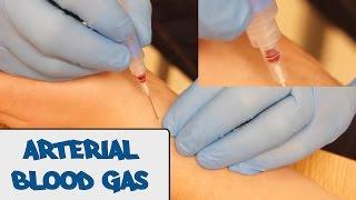 Arterial Blood Gas Sampling (ABG) - OSCE Guide (old version) | UKMLA | CPSA