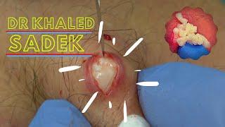 Explosive Back Cyst. Dr Khaled Sadek. LipomaCyst.com