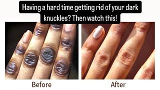 Easiest way to get rid of Dark knuckles