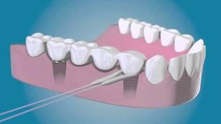 TePe Bridge & Implant Floss - für die Reinigung um die Implantate