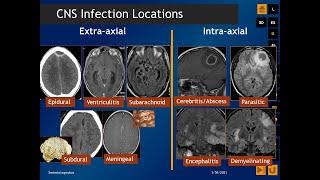 CNS Infections: Radiologic-Pathologic Correlation