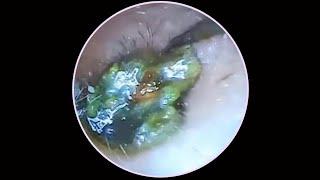 Tympanic membrane perforation and postoperative debridement for cholesteatoma EP 132