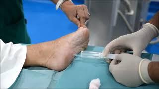 Tratamiento de la fascitis plantar con ozono - Dr. Félix Pastor