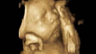 pregnacny ultrasound scan - Dublin Ireland