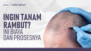 Syarat, Proses dan Biaya Tanam Rambut (Transplantasi Rambut) | Hidup Sehat tvOne