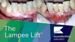 The Lampee Lift | Dental CE