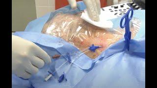 Central venous catheter insertion (Internal jugular vein)