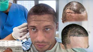 Alles zu meiner Haartransplantation!