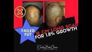 REVISION of Failed FUT Hair Transplant @Darling Buds Clinic