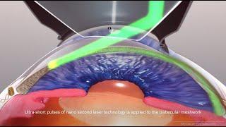 Selective Laser Trabeculoplasty (SLT) for glaucoma