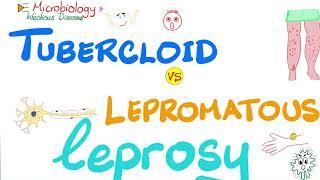 Tuberculoid Leprosy vs Lepromatous Leprosy | Comparisons Playlist