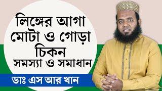 লিঙ্গের আগা মোটা ও গোড়া চিকন সমস্যা ও সমাধান #ডাএসআরখান || #DrSRKhan