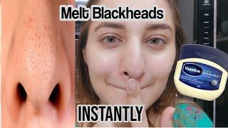 I Removed My Blackheads Instantly Korean trick. how to get rid of blackheads