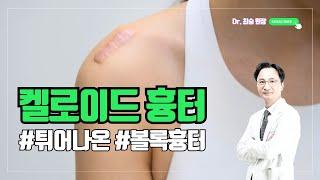 볼록하게 튀어나온 #흉터 #켈로이드 맞나요 #닥터최승 #켈로이드흉터 #수술흉터 #화상흉터 #여드름흉터