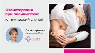 Озонотерапия при поликистозе. Врач Семенова Ирина Ивановна, клиника МЭДИС