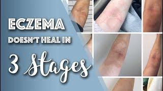 How Eczema ACTUALLY Heals (You Might be Surprised) // Michelle Mills