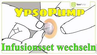 YpsoPump Infusionsset wechseln Insulinpumpe mylife Diabetescare 09