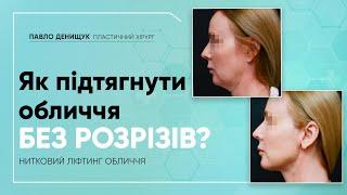 ПІДТЯЖКА ОБЛИЧЧЯ НИТКАМИ  | НИТКОВИЙ ЛІФТИНГ ОБЛИЧЧЯ | ЛІГАТУРНИЙ ЛІФТИНГ