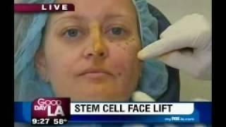 Stem Cell Face Lift On Good Day LA - Dr Nathan Newman MD