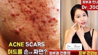 (*Eng Sub) 피부과전문의가 알려주는 여드름 스킨케어ㅣ How to Prevent Acne Scar by a Dermatologistㅣ여드름 흉터 예방법