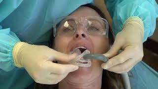 Isolite Anterior Mouthpiece Placement