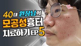 40대 원장님의 모공성흉터 치료 마지막 이야기