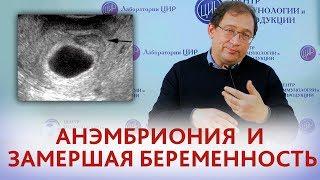 АНЭМБРИОНИЯ и замершая беременность. ЧТО ДЕЛАТЬ? Отвечает Доктор Гузов И.И.