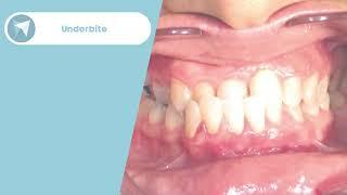 Underbite Treatment Before / After - Forest & Ray - Dentists, Orthodontists, Implant Surgeons