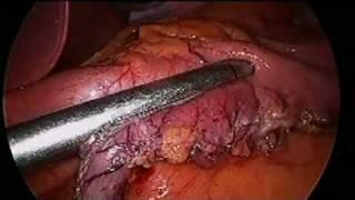 sleeve gastrectomy in male BMI 49 by Dr Craig Taylor OClinic
