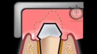 Dental Impression Materials