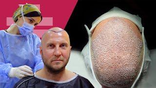 5200 Graft Sapphire Fue Hair Transplant