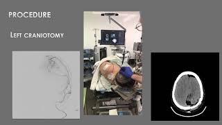 AANS Coding Shorts: Craniotomy for Resection of a Meningioma