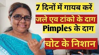 चोट के निशान कैसे मिटाये ? Pimples ke daag kaise hataye ? Tanke ke nishan kaise mitaye ?