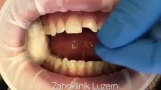 Veneers @Zahnklinik Luzern Dr.Dr.Rosanna Himmelfarb