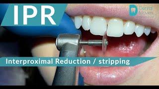 IPR 🪚 Interproximal Reduction - stripping