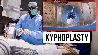 Kyphoplasty | Outpatient - Same Day Procedure for Vertebral Compression Fractures