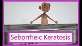 Seborrheic Keratosis (Mnemonic for the USMLE)