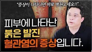 두드러기로 착각하고 방치하면 큰일나는 ‘혈관염’, 구별법은?