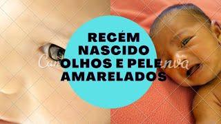 recém nascido olhos e pele  amarelados