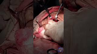 Pleomorphic Adenoma | Submandibular Gland Excision Surgery