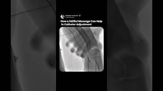 Mastering Catheter Adjustment with Gentle Massage Techniques ‍️🩺