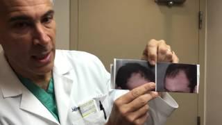 Natural-Looking Hair Transplant Results by Dr. Jeffrey Epstein