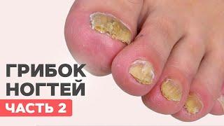 Toenail fungus part 2 | Onychomycosis cleanup