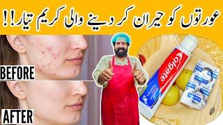 How To Remove Pimples Overnight | Acne Treatment | Remove Dark Spots |100% Effective | BaBa Food RRC