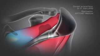 Arthroscopie de l'épaule : Acromioplastie