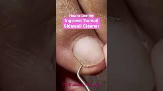 How to use the Ingrown Toenail Sidewall Cleaner #ingrowntoenail #pedicure #meticulousmanicurist