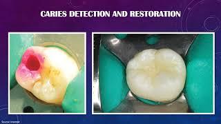 Basic and Advanced treatment modalities pertaining to Conservative dentistry and Endodontics.