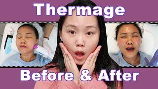 热玛吉全过程医美Vlog分享@纽约 | 3个月真实效果对比+术后护理 |My Thermage FLX Experience in New York 【Eng Subs】